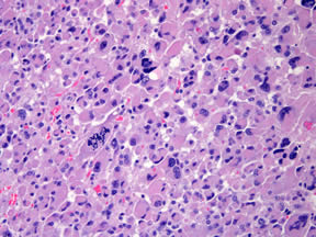 adrenal cancer cells