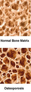 Normal bone versus Osteoporosis