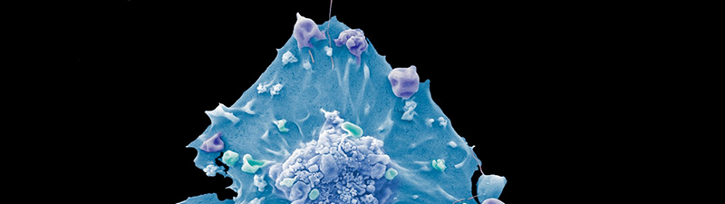 breast cancer cell