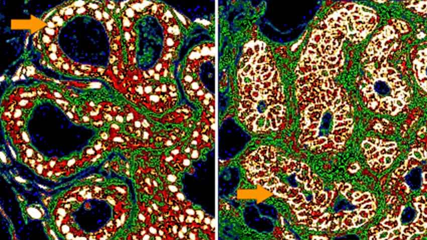 two images, one a scan of non-recurrent breast cancer and one a scan or recurrent breast cancer