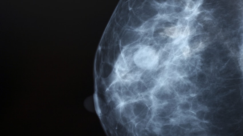 images of the four types of breast density