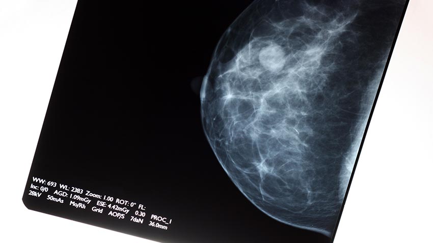 Breast scan image