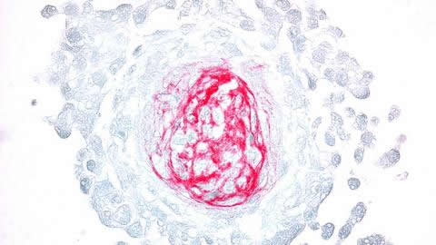 Abundant collagen (red stain) deposition in a tumorsphere composed of breast cancer cells and mesenchymal stem cells