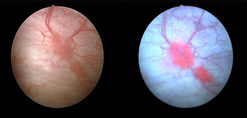 on the left is a view of the bladder in white light; on the right is the same view but with blue light, which shows tumors