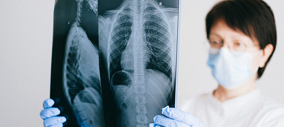 doctor looking at a chest x-ray