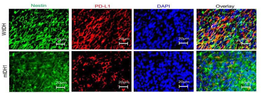 Using immunohistochemistry, the research compared gliomas with IDH1 mutations to those without. Image courtesy of the Journal of Clinical Investigation.