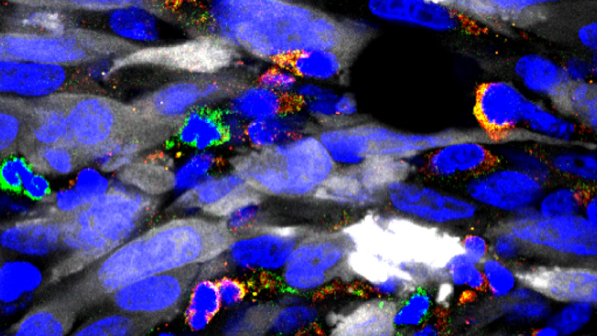 glioma tumors microscopicaly