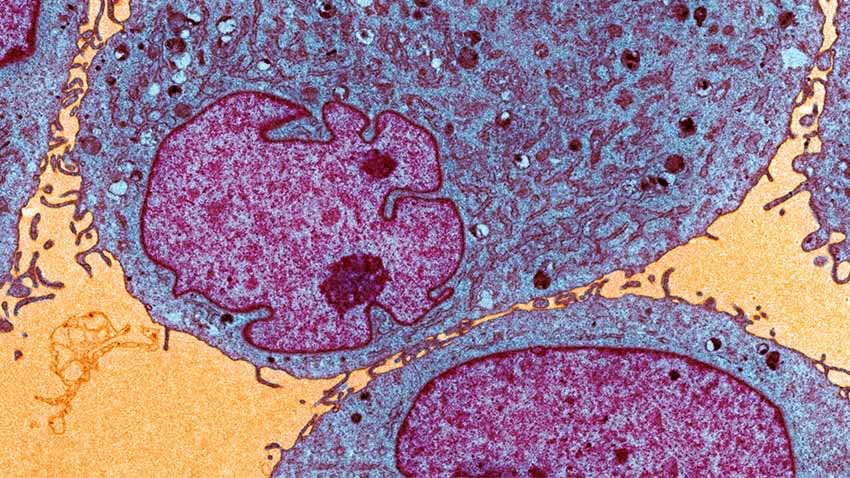 Leukemia and Lymphoma cells