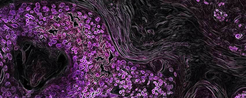 microscopic lung cancer cells dyed purple