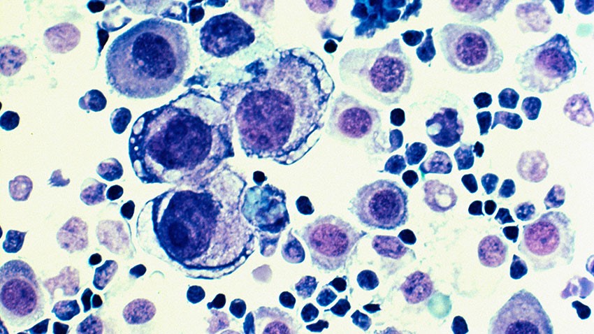 metastatic breast cancer cells under a microscope