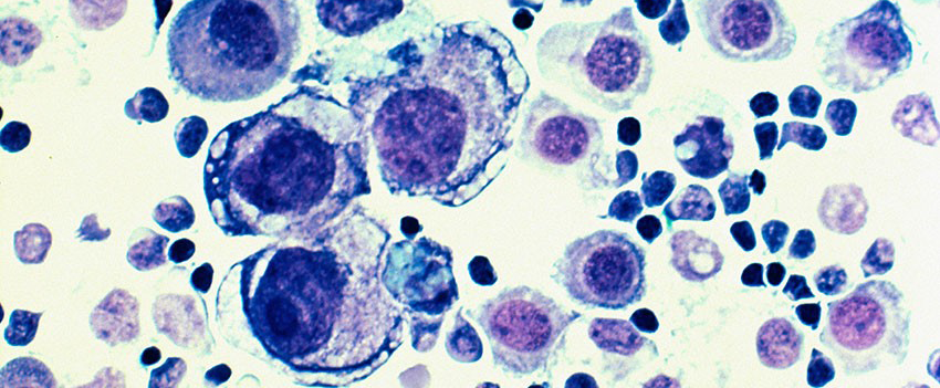 metastatic breast cancer cells