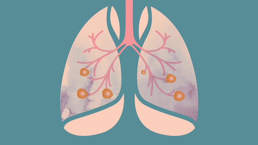 graphic of lungs animated to show how immunotherapy relived them of cancer