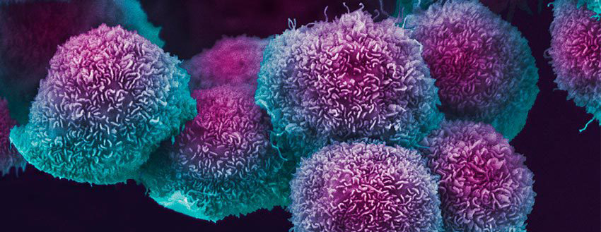an image of microscopic pancreatic cancer cells stained purple