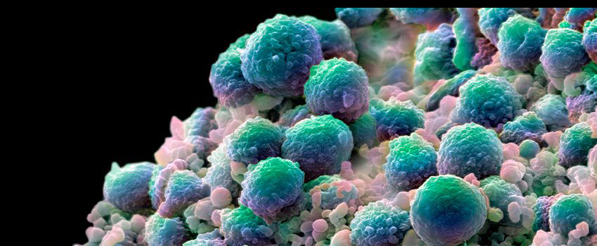 an image of microscopic prostate cancer cells stained teal