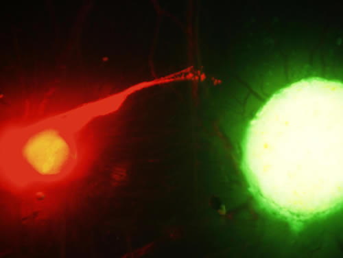 The fluorescence image shows the interaction between the nerve (red) and cancer (green)