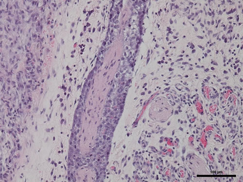 The photomicrograph shows a nerve (central structure) invaded by cancer cells