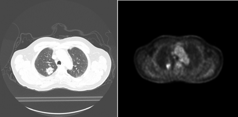 on the left, a CT scan of a lung cancer patient's lungs showing the tumor as white in black lungs on the right, a PET scan shows the same thing, but better isolates the tumor