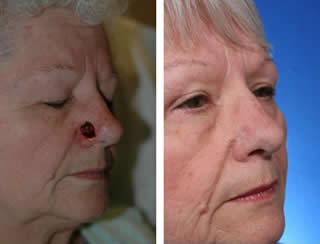 Before and after nasal reconstruction