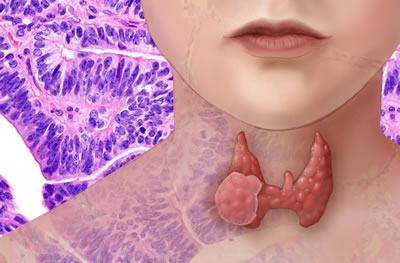 graphic of human head with thyroid gland highlighted