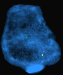 U-M scientists say fused genes trigger the development of prostate cancer