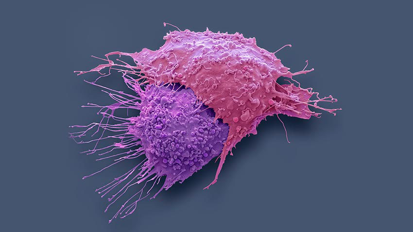 Colored scanning electron micrograph of ovarian cancer cells