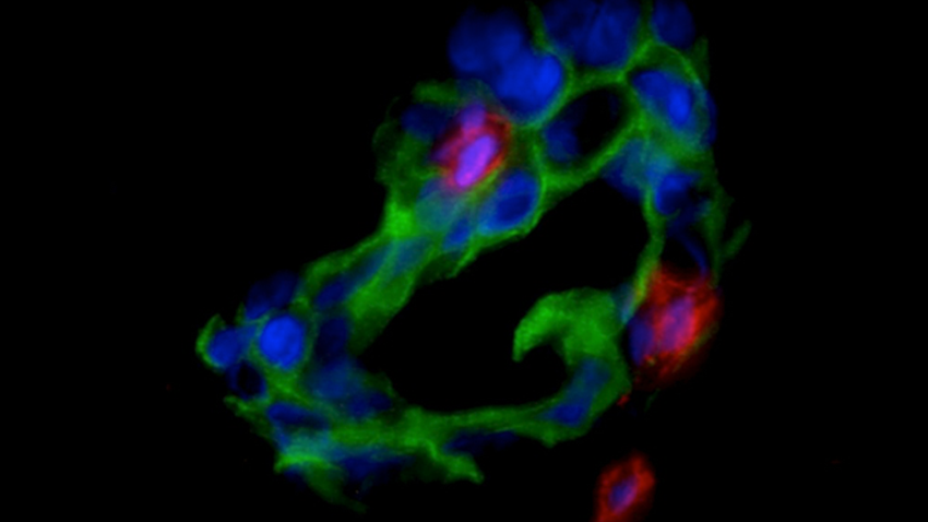 ovarian cancer cells