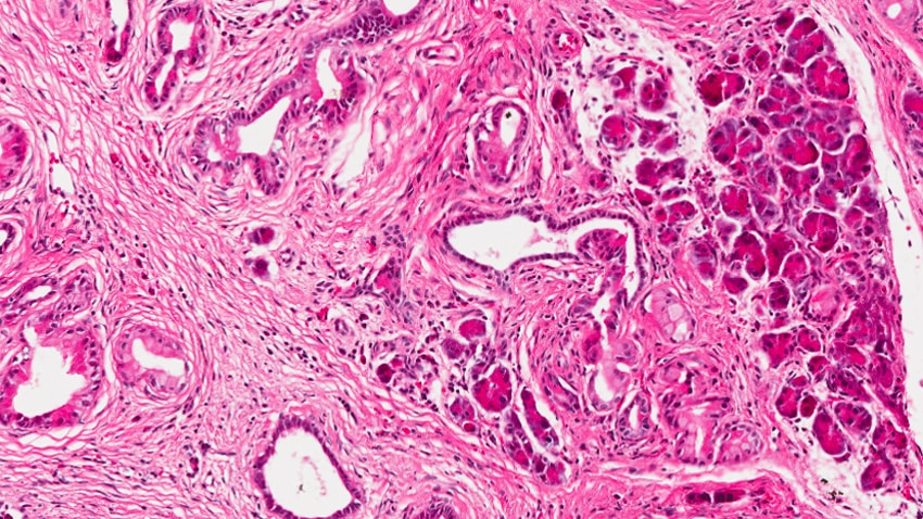 pancreatic cancer cells