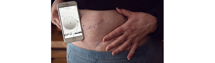 phone is held against a woman's stomach to show her scar is as big as her phone