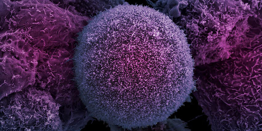 Prostate cancer cells by Anne Weston, Francis Crick Institute