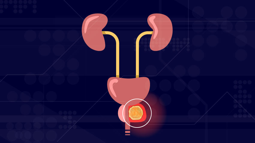 graphical representation of the male urinary system identifying the location of the prostate gland