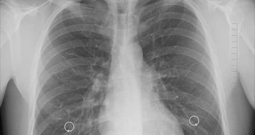 image of chest x-ray showing lung cancer