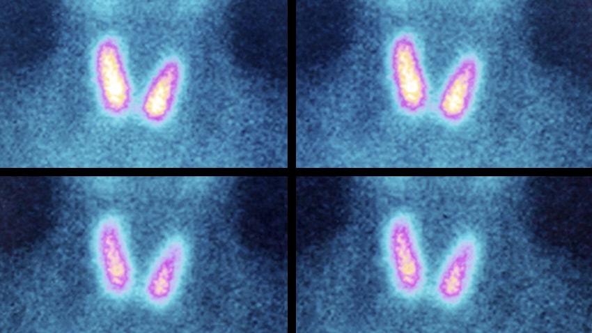 images of non-life-threatening thyroid tumors