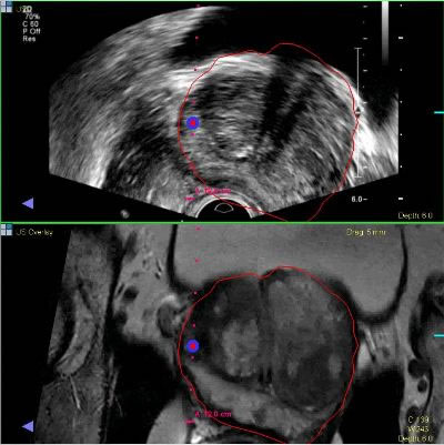 photo of what a doctor sees when using the UroNav system