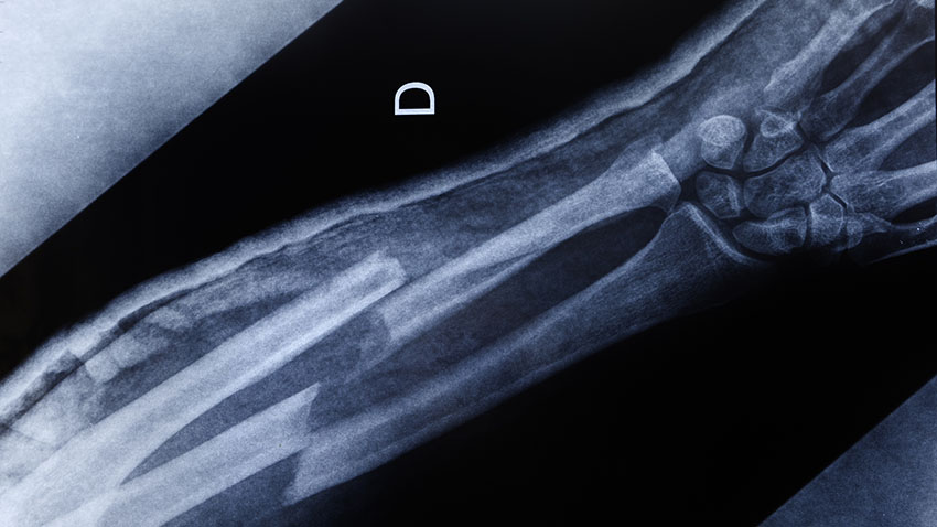 images of an x-ray of a broken arm