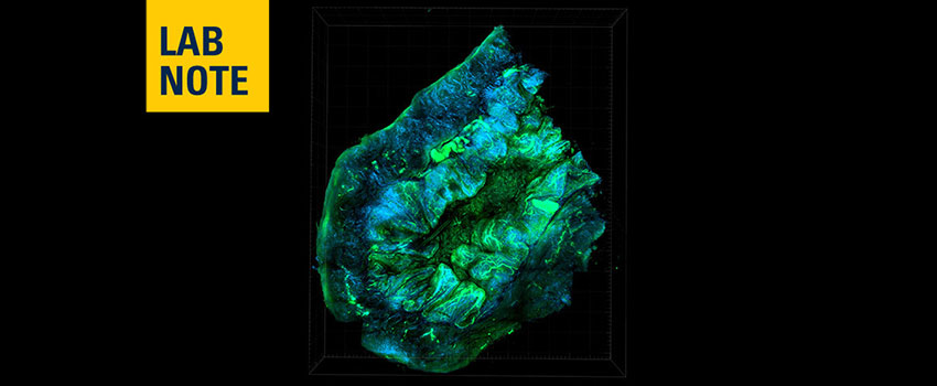 Ovarian cancer cells stained blue and green under microscope