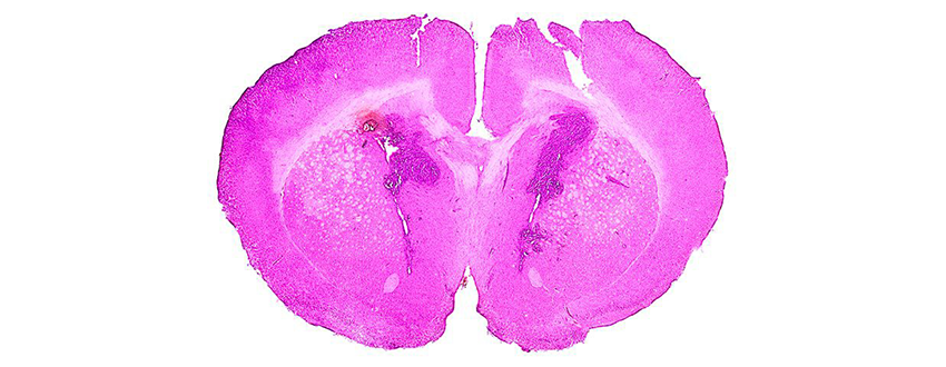 cross section of brain with tumor stained dark pink