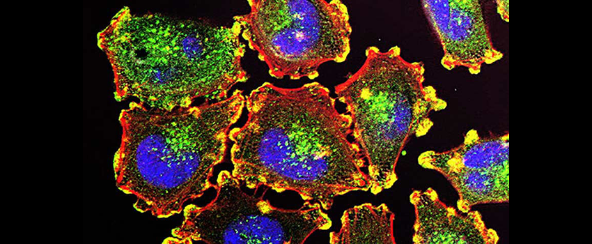 metastatic melanoma cells are stained with bright colors