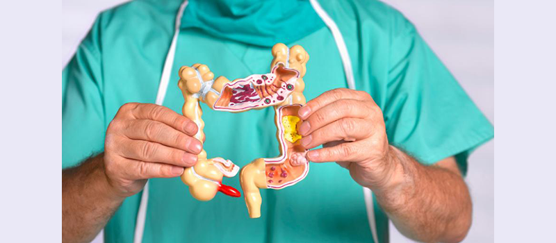 doctor holding a model of a large intestine