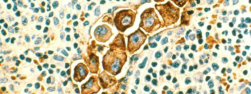 Microscopic breast cancer cells