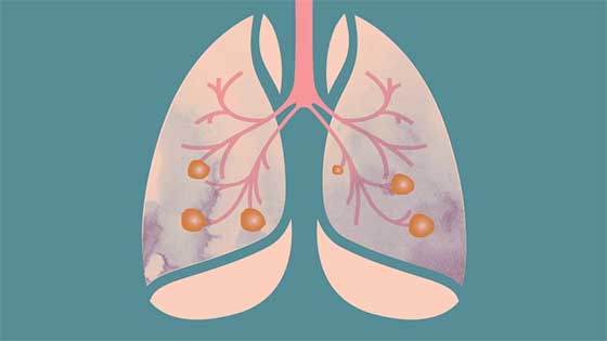 Pembrolizumab and Chemotherapy Increase Survival for Advanced Lung Cancer Patients | University of Michigan Rogel Cancer Center Pembrolizumab and Chemotherapy Increase Survival for Advanced Lung Cancer Patients | University of Michigan Rogel Cancer Center