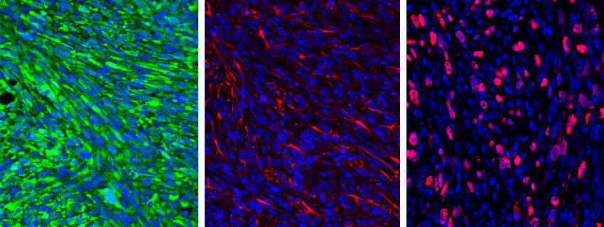 Microscopic images of nanomedicine slides along with brain cancer cells