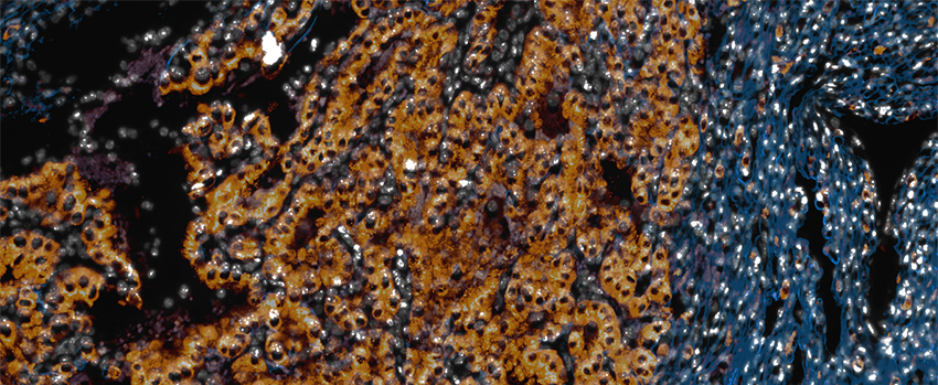 microscopic lung tissue stained to highlight normal and abnormal cells with blue or gold coloring