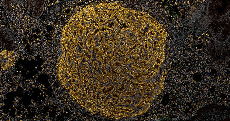Infected ALK tumor stained gold on a black background