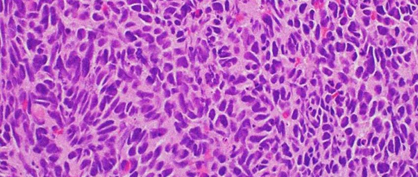 Neuroendocrine prostate cancer cells
