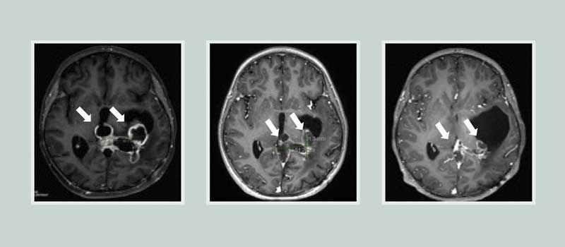 Brain scans show the tumor responding to treatment with ONC201
