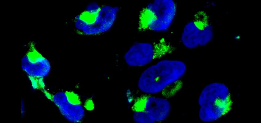 Nanoparticles from a glioma tumor stained green