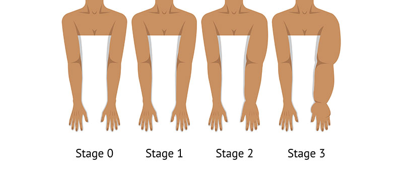 Example of the different stages of lymphedema swelling