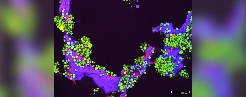 Microscopic image of multiple myeloma cells stained green