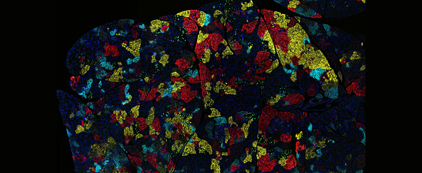 Microscopic view of colorful pancreatic cancer cells 