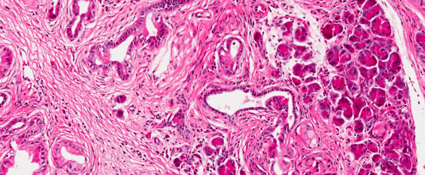 Microscopic view of pancreatic cancer cells stained pink